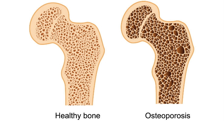 Osteoporosis