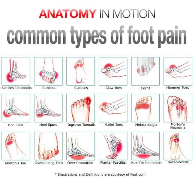 Common types of foot pain - Advance European Medicare Center